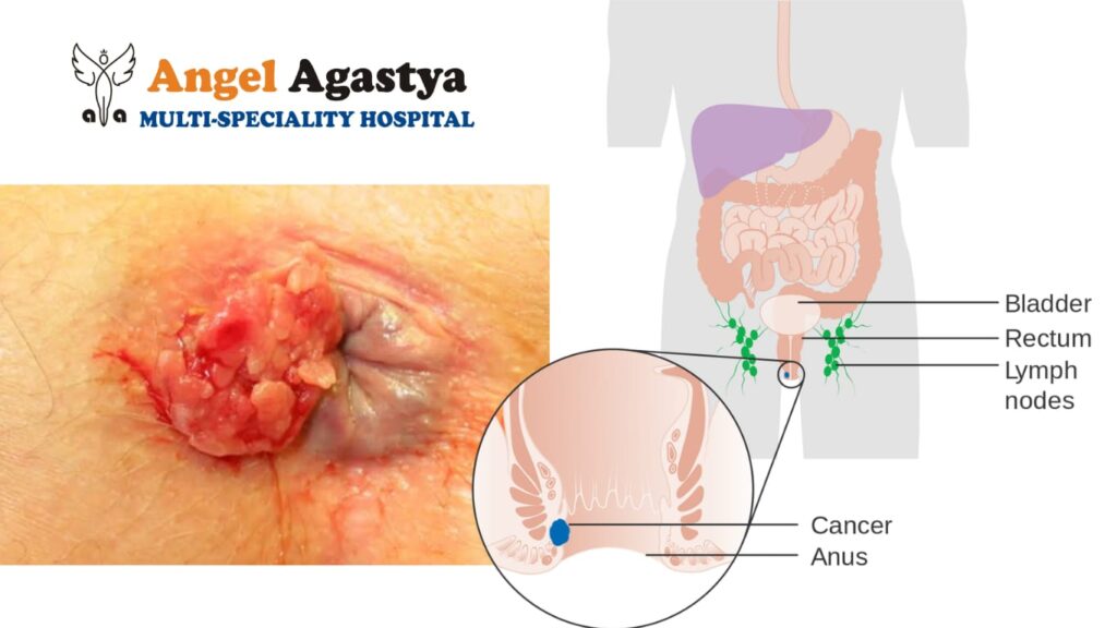 Anal cancer HPV Vaccination
