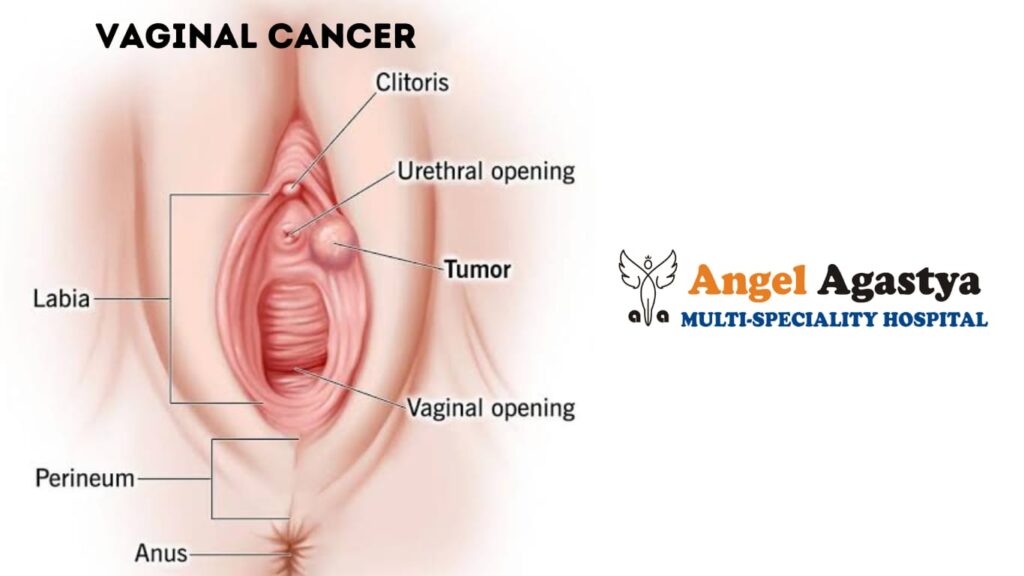 vaginal cancer
HPV vaccination
