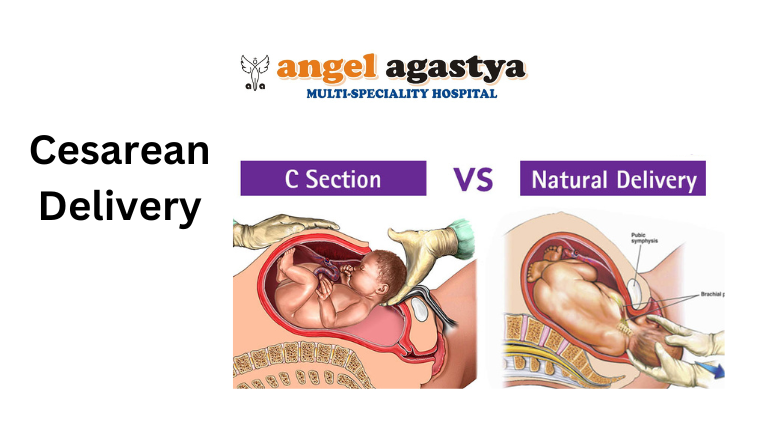 What is a Cesarean Delivery?