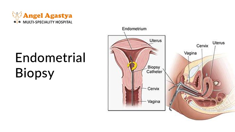 What is Endometrial Biopsy