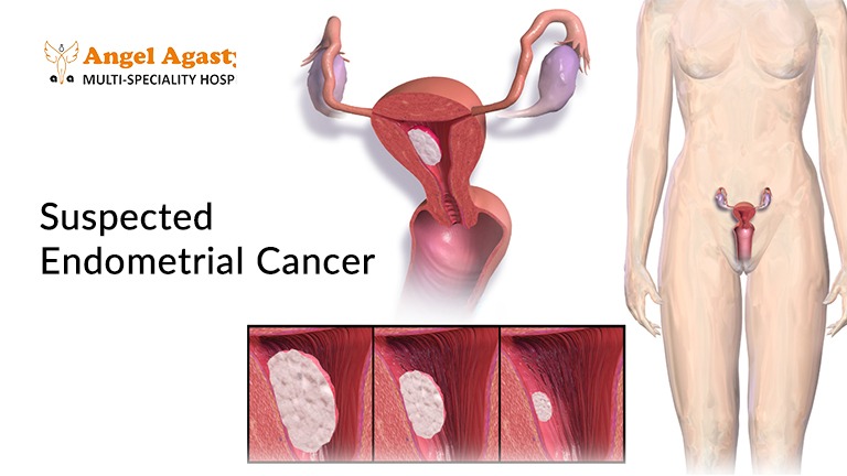 Suspected Endometrial Cancer
