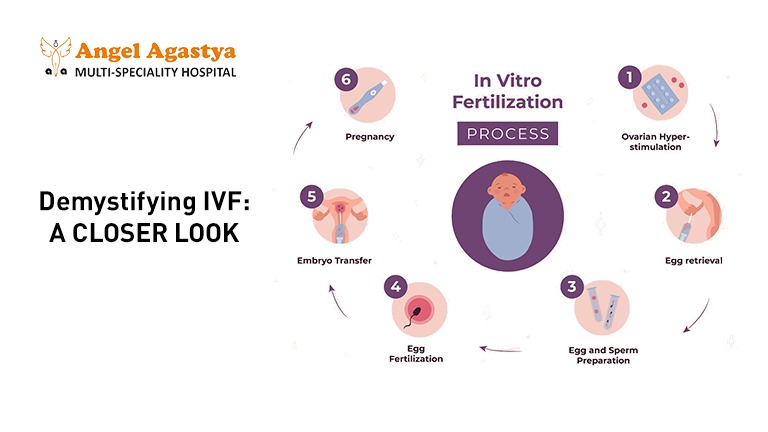 Demistifying IVF : A Closer Look