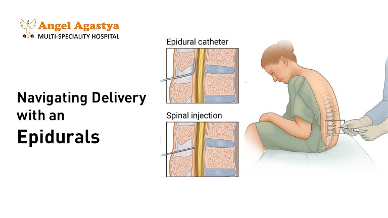 Navigating Delivery with an Epidurals