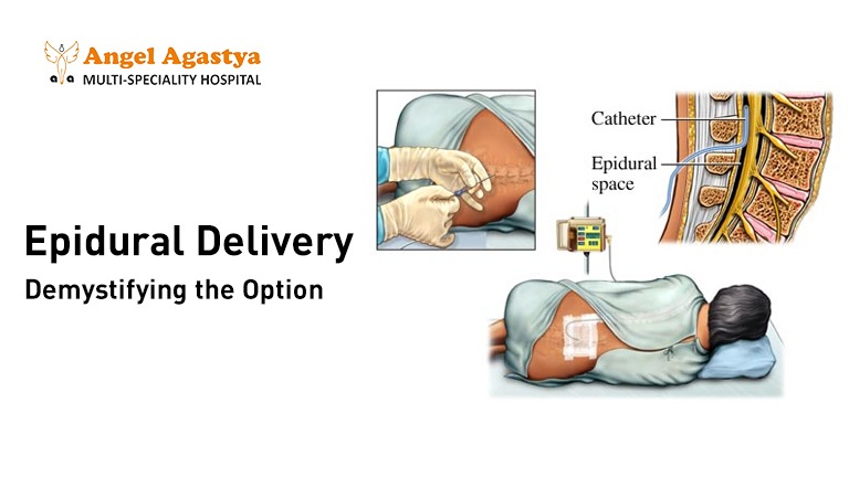 Epidural Delivery - Demystifying the Option
