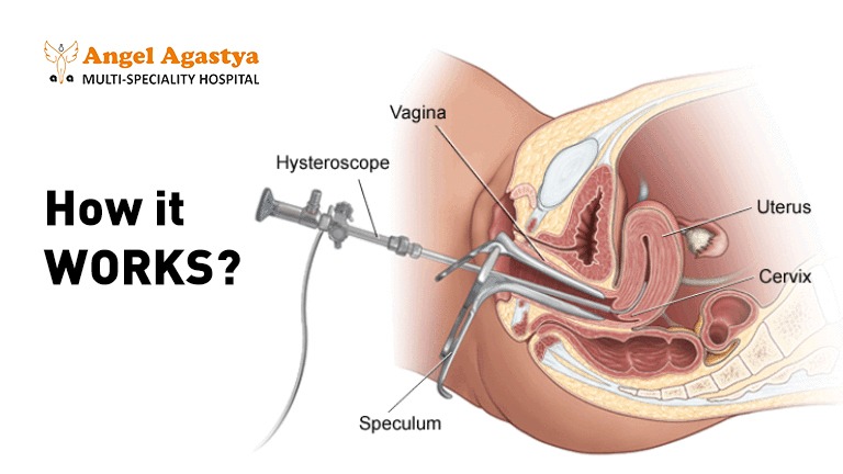 HOW the Copper T IUD works?