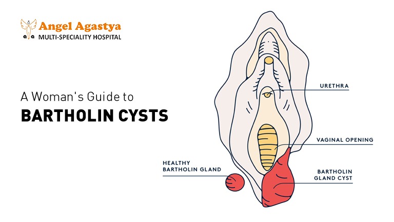 A Woman's Guide to Bartholin Cyst