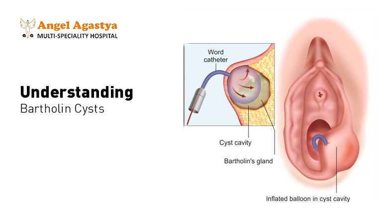 Understanding Bartholin Cyst