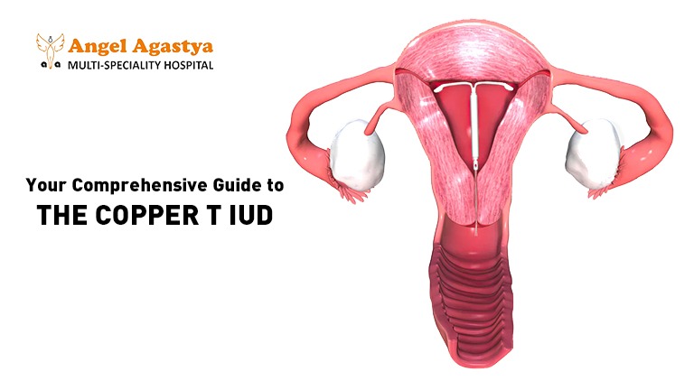 Your Comprehensive Guide to Copper T IUD