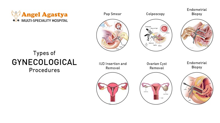 Types of Gynecological Procedures in Palam