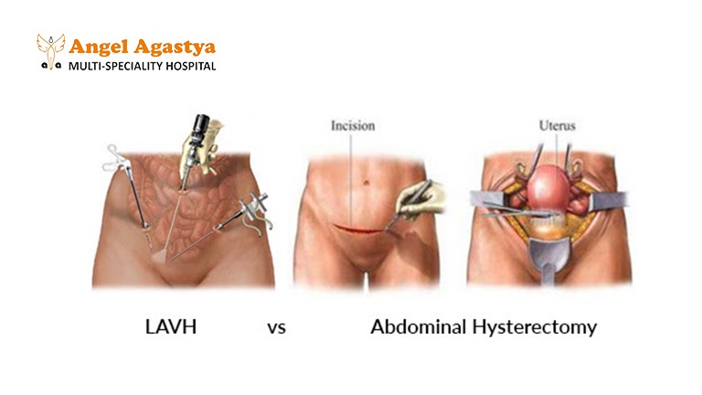 LAVH vs ABDOMINAL HYSTERECTOMY - Angel Agastya - Dr Kalpana