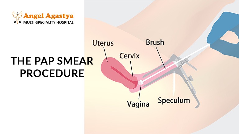 The Pap Smear Procedure