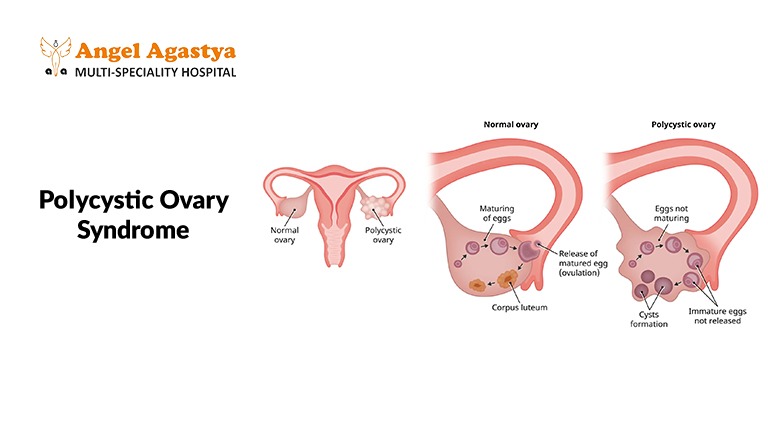PCOS and Fertility: A Complex Relationship
