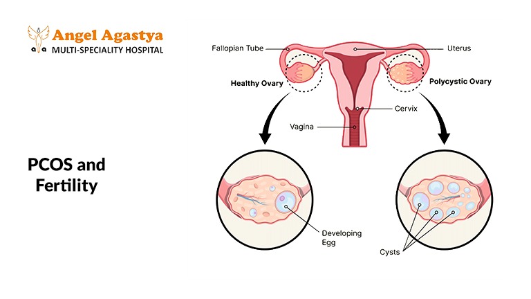 PCOS & Fertility