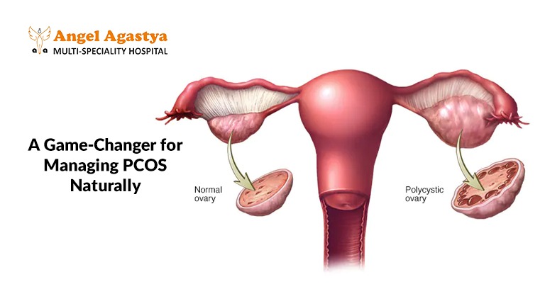 A Game-Changer for Managing PCOS Naturally: Inositol & PCOS