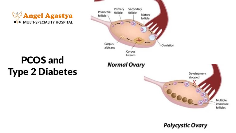 PCOS & Type 2 Diabetes