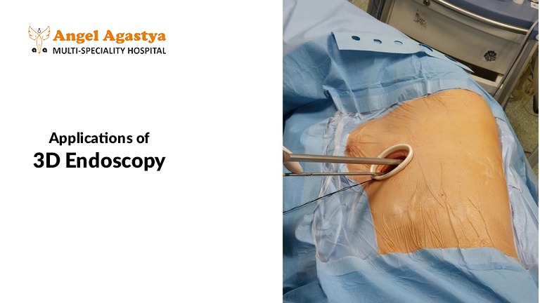 Applications of 3D Endoscopy#3D and Robotic Endoscopy