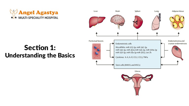 understanding the basics of Endometriosis and autoimmune disorders