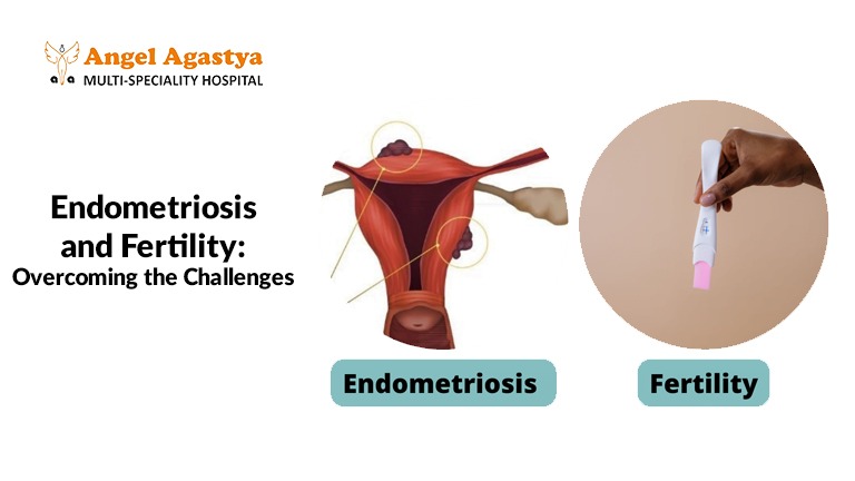 Endometriosis and fertility :overcoming the challenges
