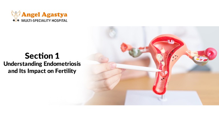 Understanding Endometriosis and Its Impact on Fertility
