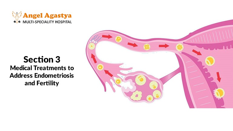 Medical Treatments to Address Endometriosis and Fertility