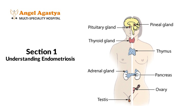 What Is Endometriosis
