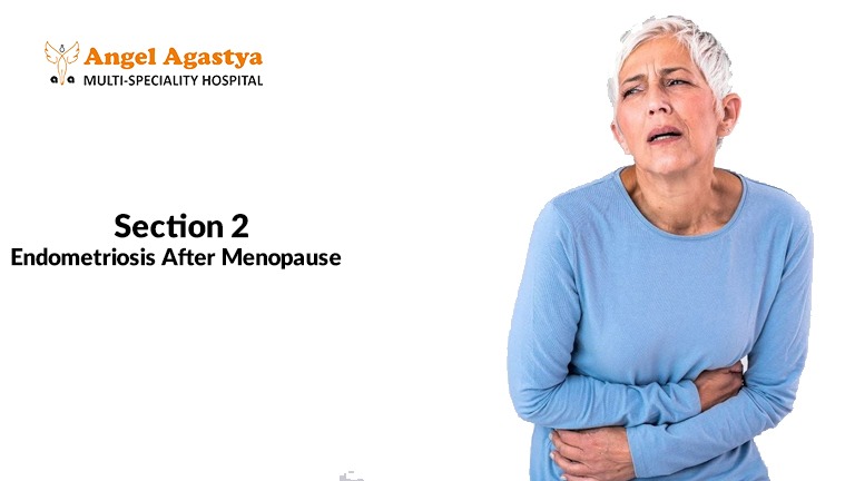 Endometriosis After Menopause
