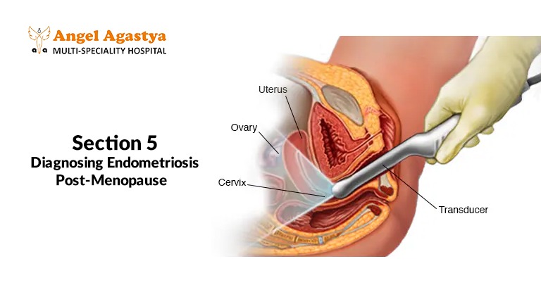 Diagnosing Endometriosis Post-Menopause