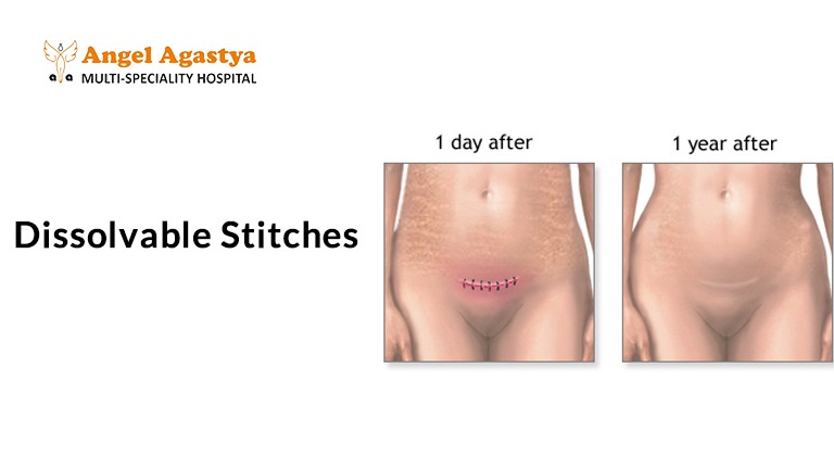 Dissolvable Stitches