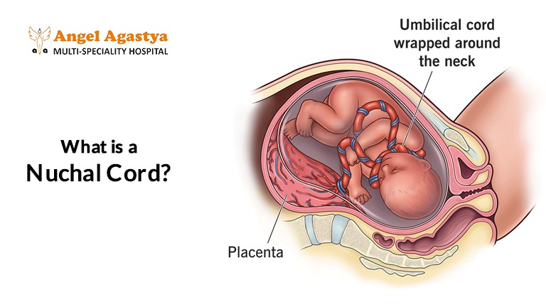 Nuchal Cord