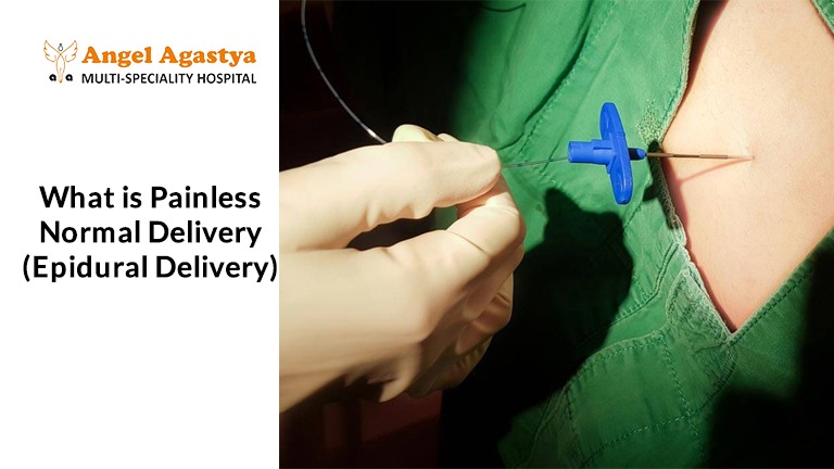 Epidural Delivery