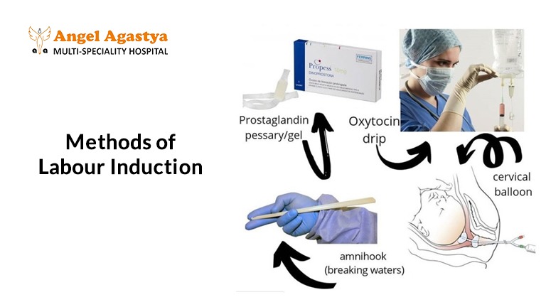 methods of labour induction