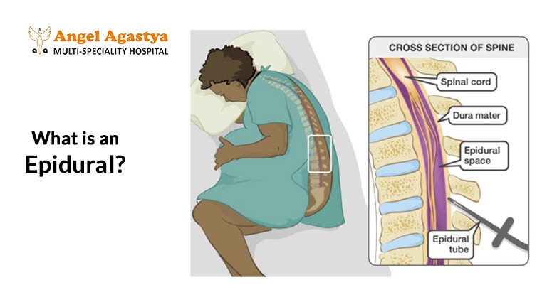 What is an Epidural?