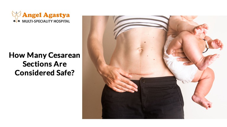 Multiple Cesarean Sections