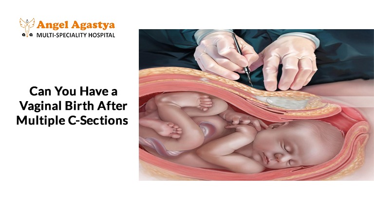 Multiple Cesarean Sections