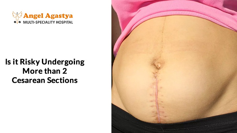 Multiple Cesarean Sections