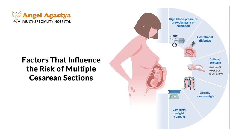 Multiple Cesarean Sections