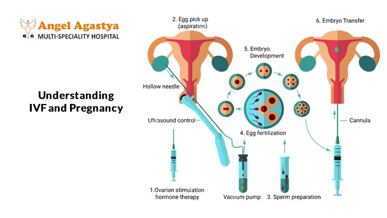 IVF Delivery
