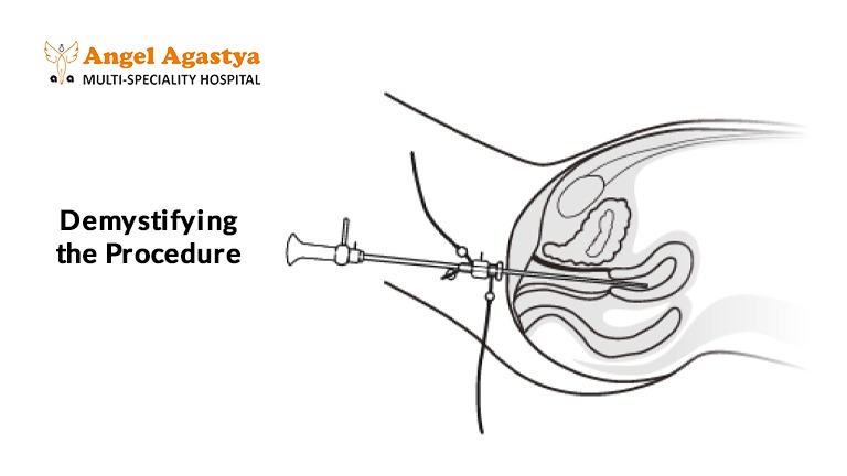 Demystifying the Procedure Demystifying the Procedure