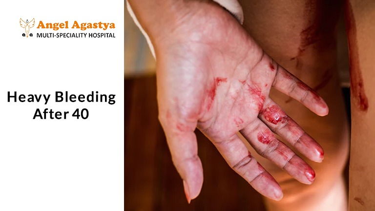 Heavy Bleeding After 40 Heavy Bleeding After 40