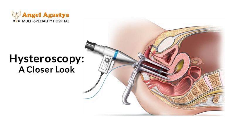 Hysteroscopy A Closer Look