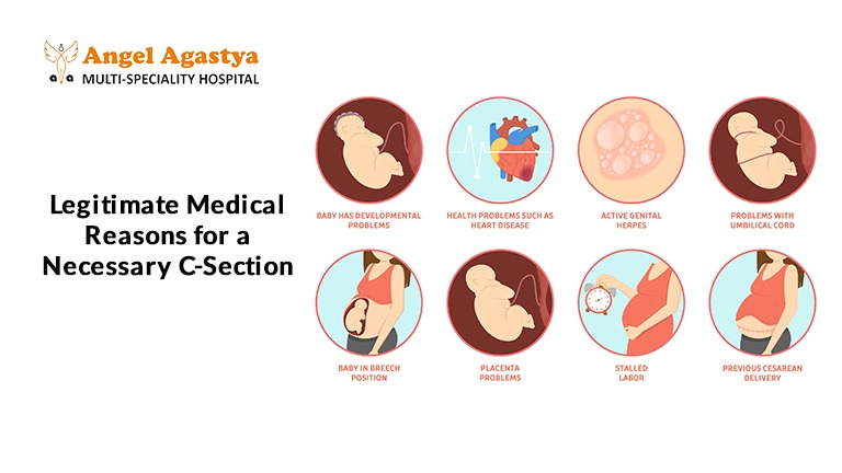 Legitimate Medical Reasons for a Necessary C-Section