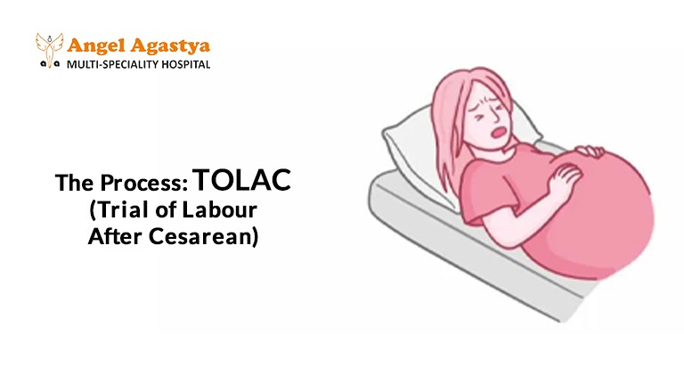 TOLAC (Trial of Labour After Cesarean) TOLAC (Trial of Labour After Cesarean)
