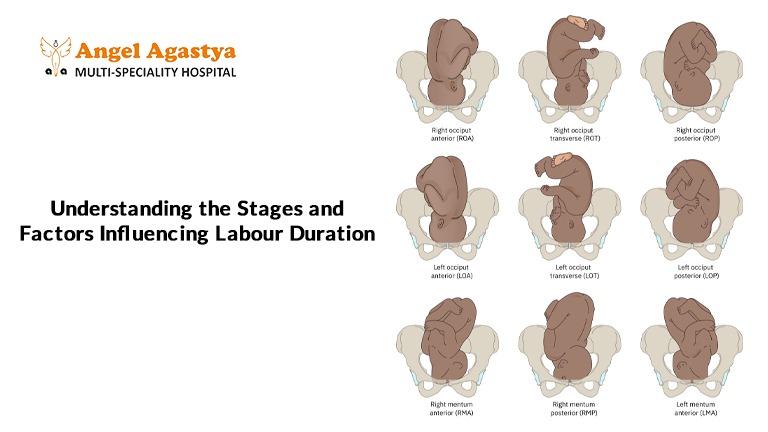 Understanding the Stages and Factors Influencing Labour Duration Understanding the Stages and Factors Influencing Labour Duration