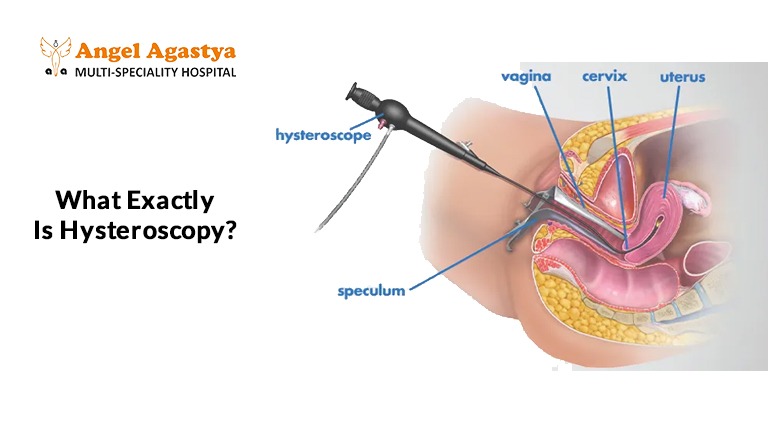 What Exactly Is Hysteroscopy What Exactly Is Hysteroscopy