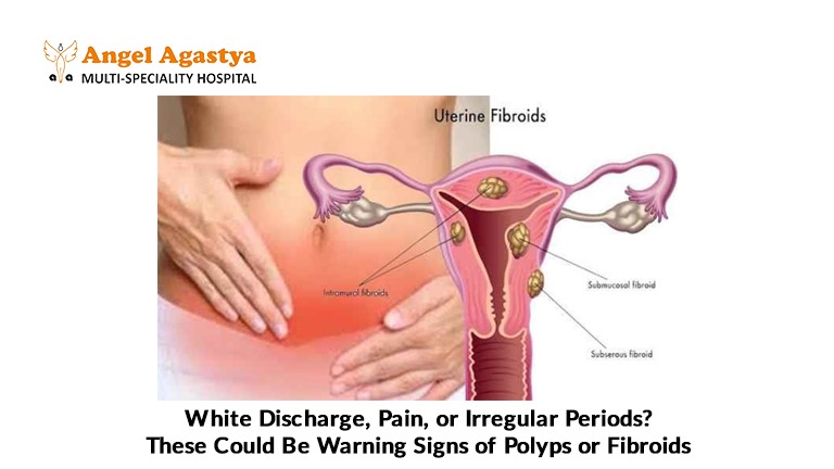 White Discharge, Pain or Irregular Periods? These Could Be Warning Signs of Polyps or Fibroids White Discharge, Pain or Irregular Periods? These Could Be Warning Signs of Polyps or Fibroids