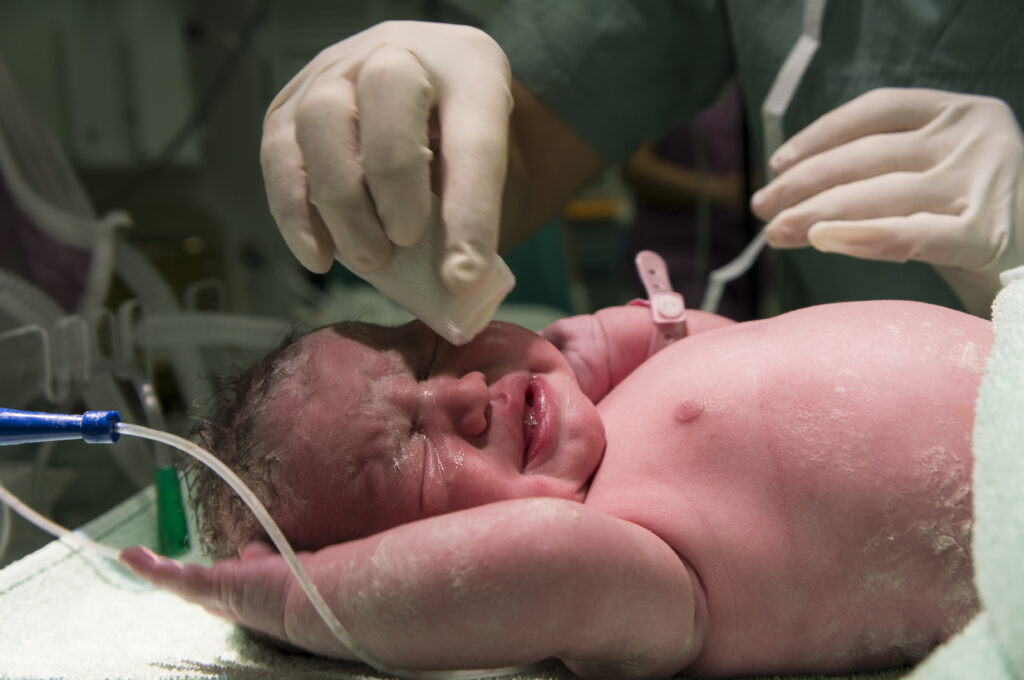 Normal Delivery vs C-Section
