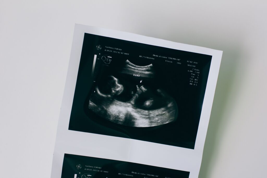 Detailed close-up of a pregnancy ultrasound showing developing fetus.