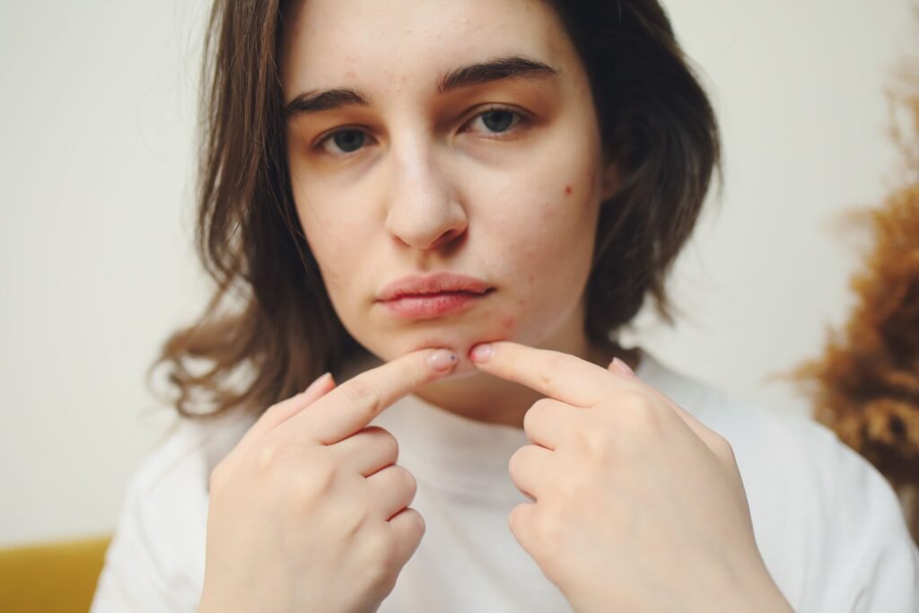 Close-up of a woman with acne touching her face, highlighting skin care concerns.